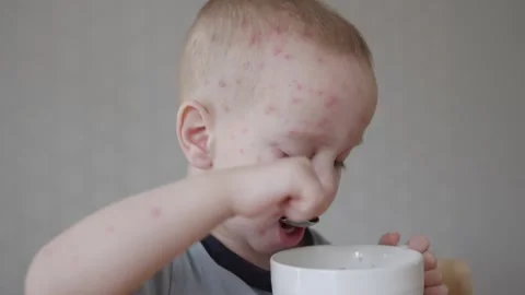 Little boy affected with chickenpox eats from plate with spoon face covered in Stock Footage 281294471