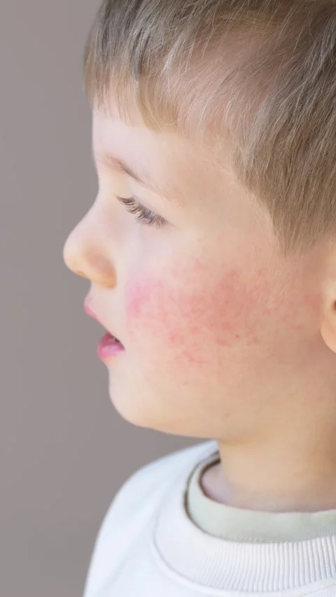 Little boy with red cheeks and visible rash showing allergy, atopic dermatitis Stock-Footage 330973205