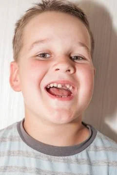 Little boy with a torn front first milk tooth Stock Photos
