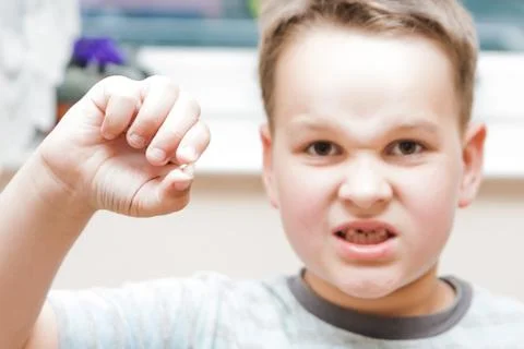 Little boy with a torn front first milk tooth Stock Photos