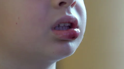 Little Boy's Face with Swollen Split Lip Stock Footage 301094782