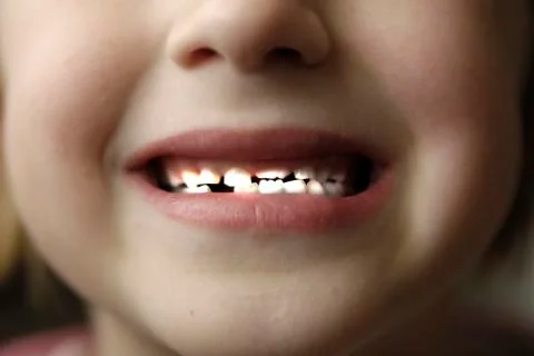 Little Kid Lost Teeth Empty Space Foto stock