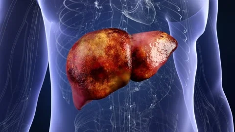 Liver cysts getting better, liver diseases being treated with medicines Vidéo 344102617