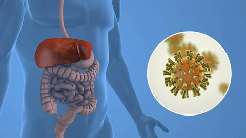 Liver Damage Due to Hepatitis C Infection Stock Illustration