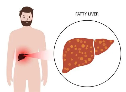 Liver disease concept Stock Illustration