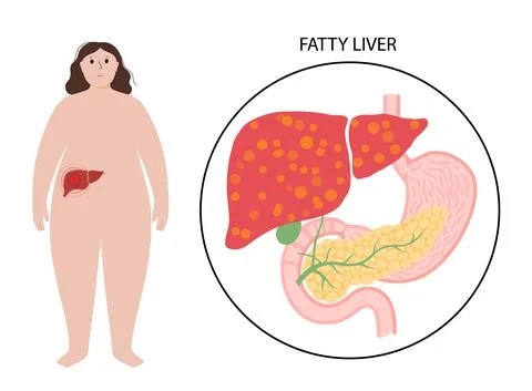 Liver disease concept Stock Illustration