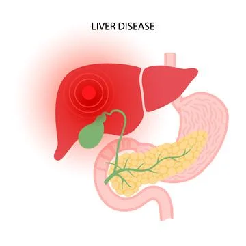 Liver disease concept Illustrazione stock