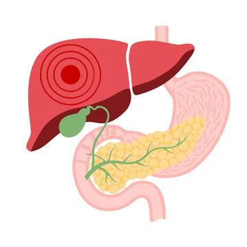 Liver disease concept Stock Illustration