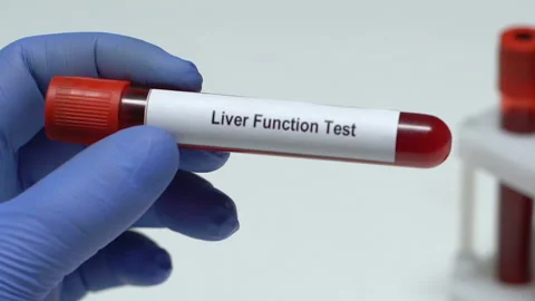 Liver Function Test, doctor holding blood sample in tube close-up, health Stock Footage 105052961