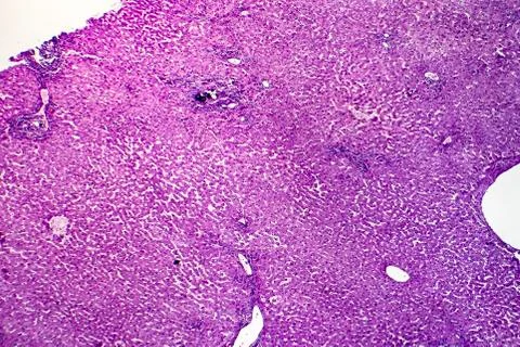 Liver schistosomiasis, light micrograph Photos