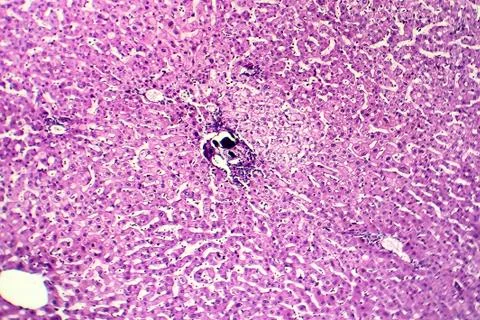 Liver schistosomiasis, light micrograph Photos