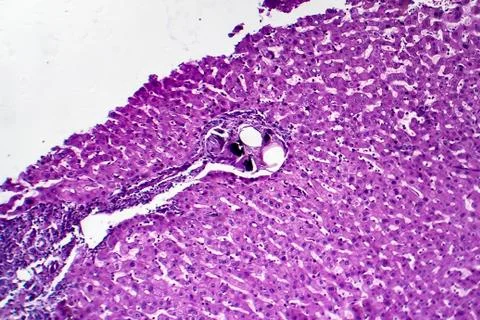 Liver schistosomiasis, light micrograph Photos