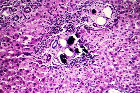 Liver schistosomiasis, light micrograph Photos
