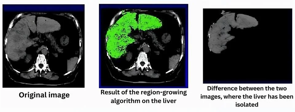 Liver Segmentation Using Region-Growing Algorithm in Medical Imaging Stock Photos