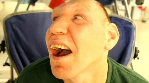 Living with microcephaly 2 Stock Footage 769838