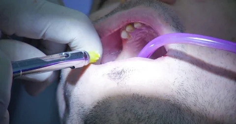 Local plexus anesthesia Stock Footage 70172115