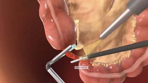 Locating and Grasping the Appendix Stock Footage 231402707