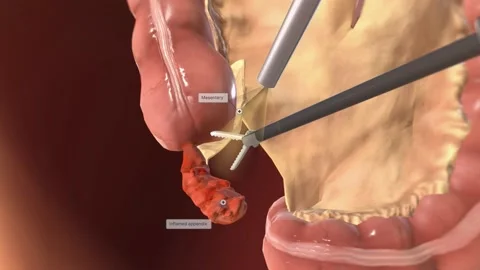 Locating and Grasping the Appendix Stock Footage 231402710