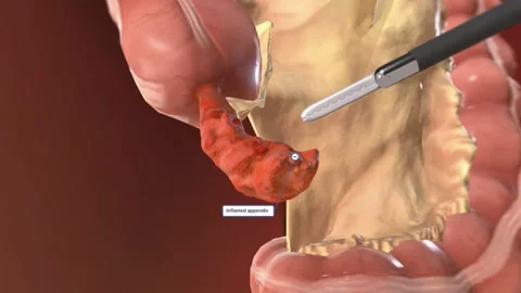 Locating and Grasping the Appendix Stock Footage 231402715