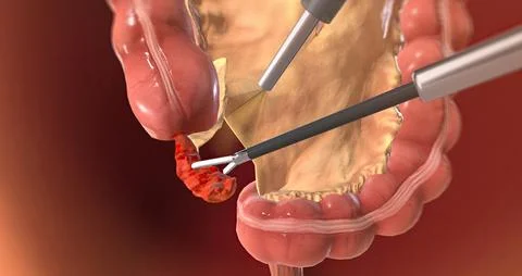 Locating and Grasping the Appendix Stock Illustration