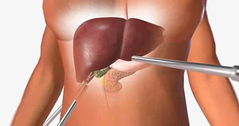 Locating and Retracting the Gallbladder Stock Illustration