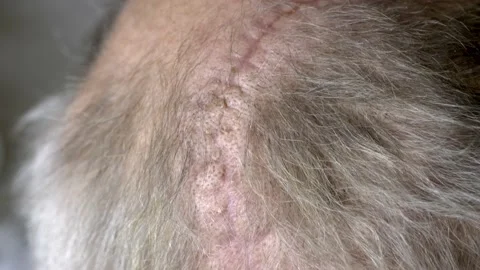 A long cicatrix over the head after an operation Stock Footage 175088172