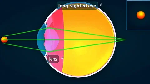 Long sighted eye nearby object Vídeos de archivo 320657241