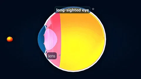 Long-sightedness or hyperopia Video stock 320657432