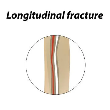 Longitudinal bone fracture. Infographics. Vector illustration on a lined Illustrazione stock