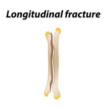Longitudinal bone fracture. Infographics. Vector illustration on a lined Stock Illustration