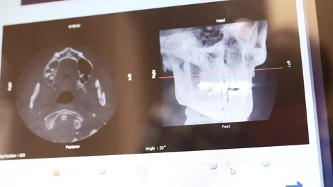 Looking at 3D x-ray of teeth and jaw on computer 動画素材 113673465