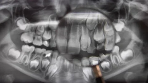 Looking at Panoramic Dental X-Ray Image through Magnifying Glass POV Stock Footage 147610707