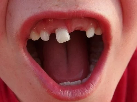 Loose Front Tooth Stock Photos
