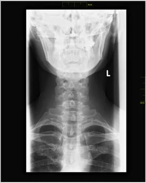Lordosis Stock Photos