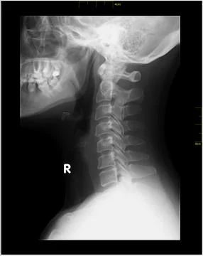 Lordosis Stock Photos