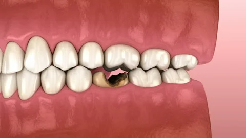 Losing molar tooth. 3D animation of human teeth and dentures concept Stock Footage 106389696