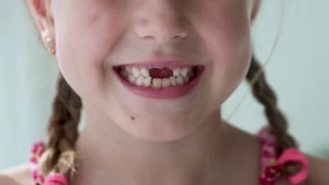 Loss of milk teeth, replacement of permanent teeth. Stock Footage 141809387