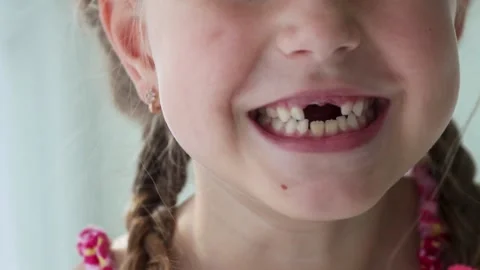 Loss of milk teeth, replacement of permanent teeth. Stock Footage 141809398