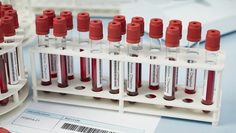 Lots of blood samples awaiting tests. Positive. Viral infection. Tube. Lab 4k HD Stock Footage