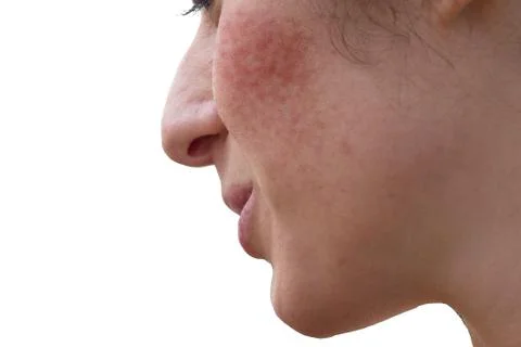 A low angle and side view on the cheek of a caucasian girl in her twenties su 스톡 사진