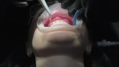 Low angle view of a female patient's mouth with a retractor during a Stock Footage 339274194