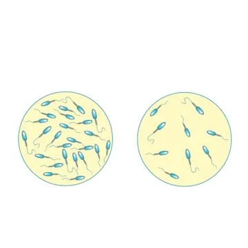 Low sperm count in seminal fluid. Low abundance of sperm in the ejaculate. Male Stock Illustration