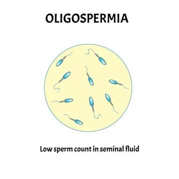 Low sperm count in seminal fluid. Low abundance of sperm in the ejaculate. Male Stock Illustration