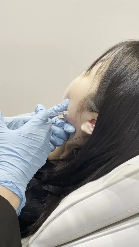 Lower Face Aesthetic Injection Procedure 4K Beauty Treatment Close-Up 2 Stock Footage 311058707