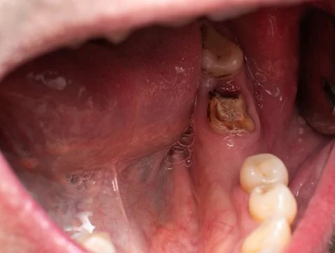 Lower second molar almost reduced to the gum Stock Photos