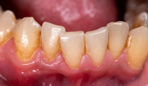 Lower teeth with plaque around them, closeup Foto stock