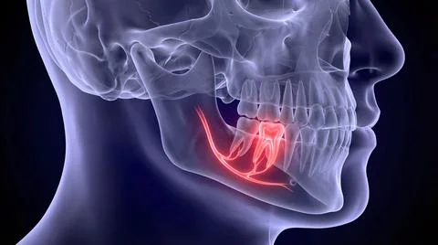 Lower wisdom tooth impaction causing intense inflammation and nerve agony Stock Illustration