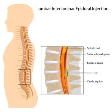 Lumbar interlaminar epidural injection Stock Illustration