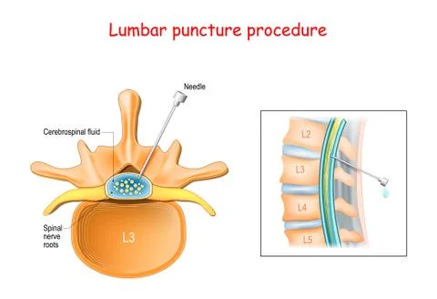 Lumbar puncture procedure. Stock Illustration