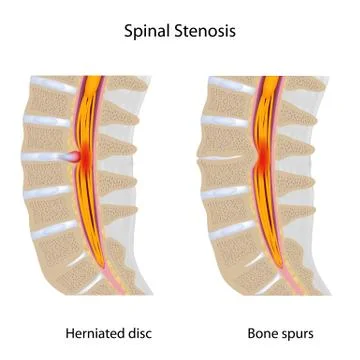 Lumbar spinal stenosis Stock Illustration